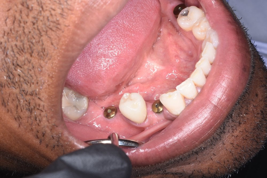 Slider image (4) Dental Implants in Colombia Dr Johanna Calderon